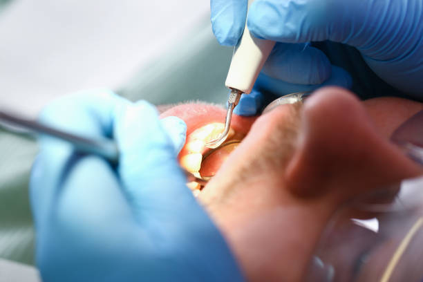 Best Emergency Wisdom Tooth Extraction in Chattahoochee, FL